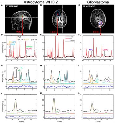 Mapping an Extended Metabolic Profile of Gliomas Using High-Resolution 31P MRSI at 7T